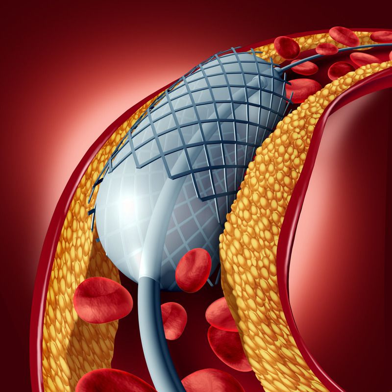 angioplasty-balloon-in-artery-graphic-angioplasty-procedure